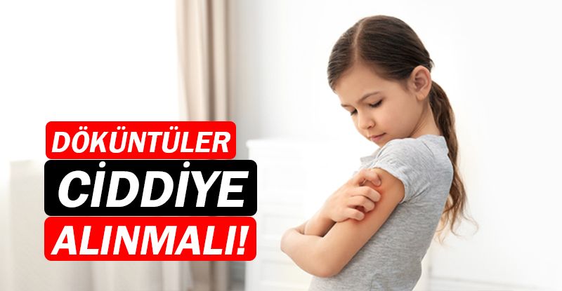 Çocuklarda ciddiye alınması gereken döküntüler